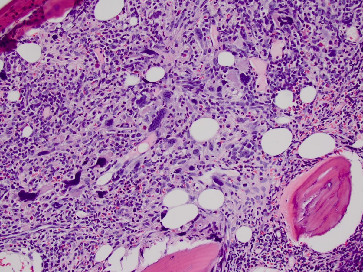 Focus of Myeloproliferative neoplasm 